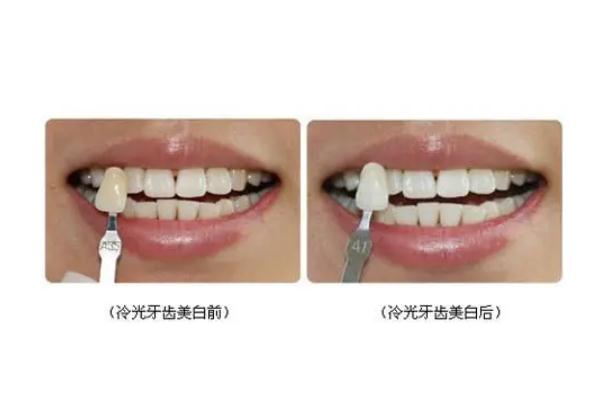 冷光美白牙齒要做幾次 牙齒冷光美白的機理 冷光美白牙齒要做幾次 牙齒冷光美白的機理