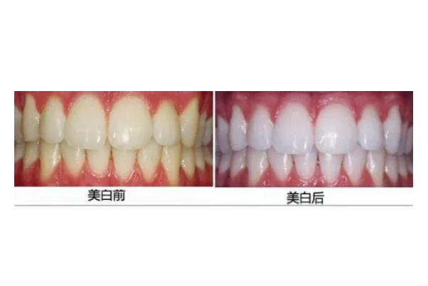 冷光美白牙齒是立馬見(jiàn)效嗎 冷光美白牙齒是紫外線照射嗎