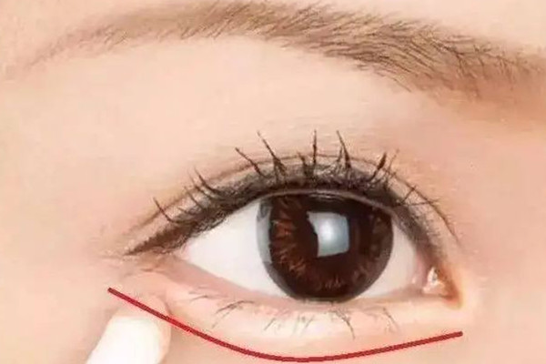 淚溝填充失敗怎么修復(fù) 淚溝填充后多久能看到效果 淚溝填充失敗怎么修復(fù) 淚溝填充后多久能看到效果