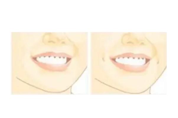 人造酒窩和天生的酒窩區(qū)別 人造的酒窩自然嗎 人造酒窩和天生的酒窩區(qū)別 人造的酒窩自然嗎