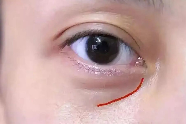 淚溝填充可以維持多久 淚溝填充多久才能恢復自然