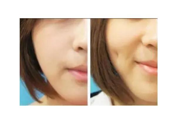 人造酒窩會消失嗎 酒窩成形術(shù)適合臉頰消瘦的人嗎 人造酒窩會消失嗎 酒窩成形術(shù)適合臉頰消瘦的人嗎