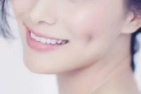 人造酒窩會消失嗎 酒窩成形術(shù)適合臉頰消瘦的人嗎 人造酒窩會消失嗎 酒窩成形術(shù)適合臉頰消瘦的人嗎