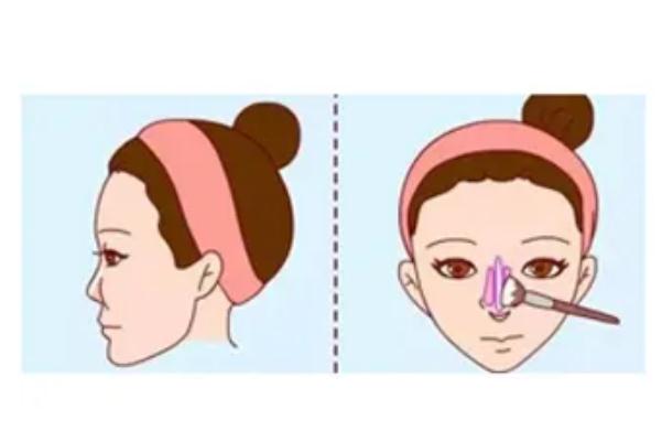 朝天鼻矯正有后遺癥么 朝天鼻該如何矯正過(guò)來(lái)