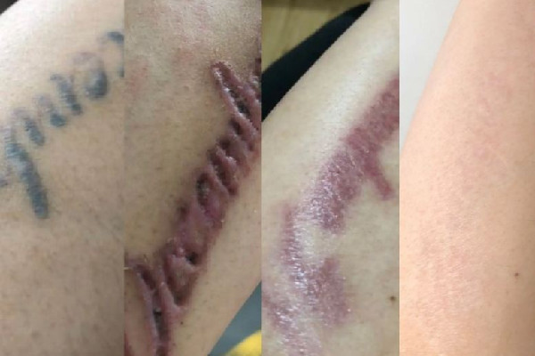 洗紋身敷麻藥嗎 洗紋身敷麻藥對(duì)人體有沒有傷害