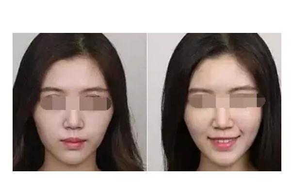 蘋(píng)果肌復(fù)位的注意事項(xiàng) 蘋(píng)果肌復(fù)位后要戴面罩嗎