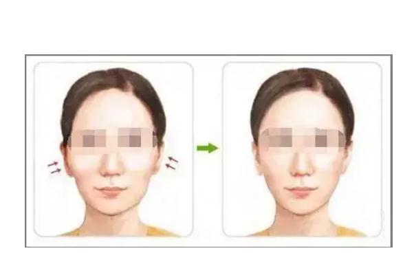 顴骨內(nèi)推和磨骨哪個風(fēng)險大 顴骨內(nèi)推的危害 顴骨內(nèi)推和磨骨哪個風(fēng)險大 顴骨內(nèi)推的危害