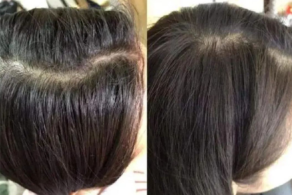 頭發(fā)愛(ài)出油還脫發(fā)怎么辦 頭發(fā)為什么總是很油