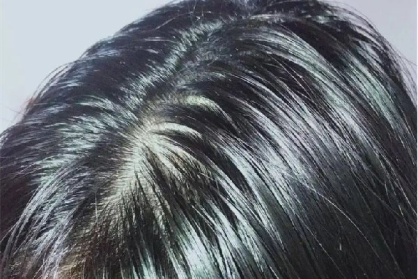 頭發(fā)愛(ài)出油還脫發(fā)怎么辦 頭發(fā)為什么總是很油