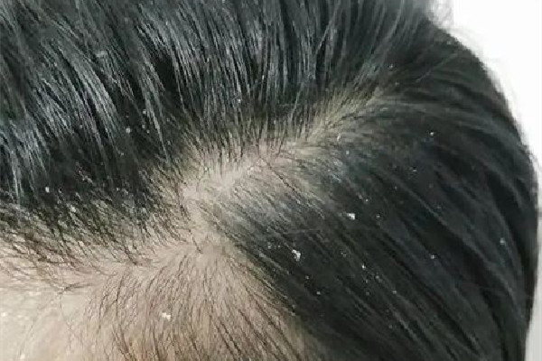 頭發(fā)愛(ài)出油還脫發(fā)怎么辦 頭發(fā)為什么總是很油