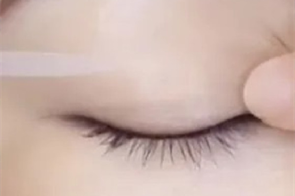 雙眼皮貼貼久了眼皮松怎么辦 雙眼皮貼有副作用嗎 雙眼皮貼貼久了眼皮松怎么辦 雙眼皮貼有副作用嗎