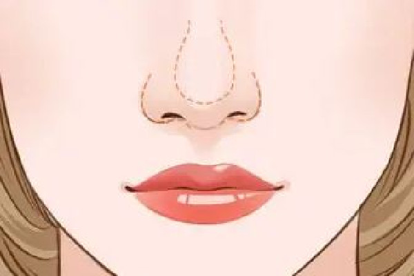 武漢鼻翼縮小好的醫(yī)院 武漢鼻翼縮小手術(shù)多少錢(qián)