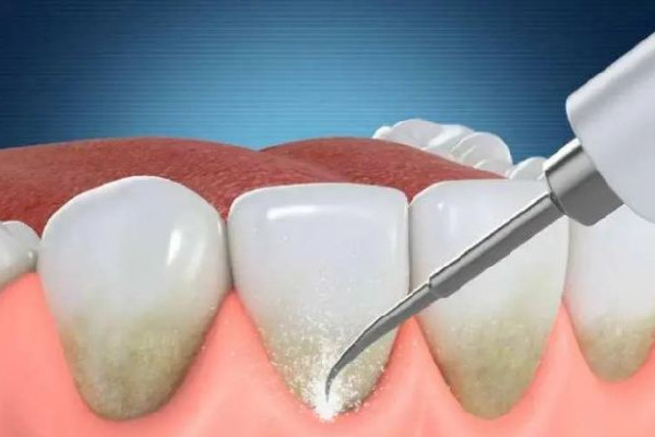 武漢洗牙較好的醫(yī)院 武漢洗牙一次大概多少錢(qián) 武漢洗牙較好的醫(yī)院 武漢洗牙一次大概多少錢(qián)