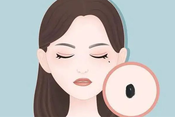 武漢激光點痣醫(yī)院哪家好 武漢點痣哪里弄的干凈 武漢激光點痣醫(yī)院哪家好 武漢點痣哪里弄的干凈