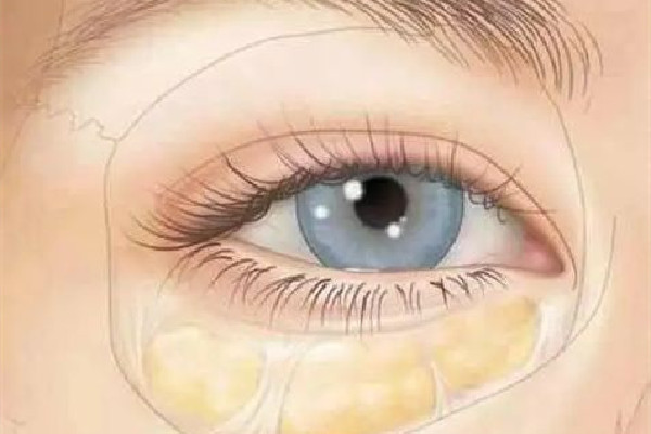 武漢淚溝填充哪家比較好 武漢哪家醫(yī)院淚溝修復好