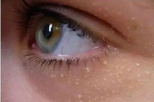 武漢去脂肪粒那家醫(yī)院比較好 武漢去脂肪粒多少錢