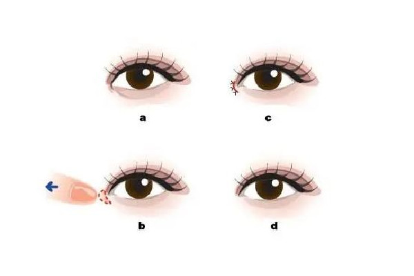 武漢開(kāi)內(nèi)眼角醫(yī)院 武漢開(kāi)內(nèi)眼角多少錢 武漢開(kāi)內(nèi)眼角醫(yī)院 武漢開(kāi)內(nèi)眼角多少錢