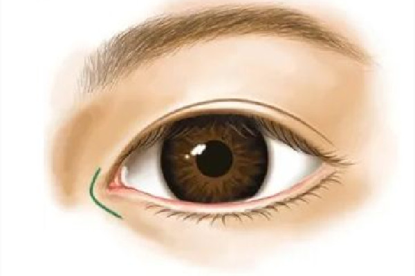 武漢開(kāi)內(nèi)眼角醫(yī)院 武漢開(kāi)內(nèi)眼角多少錢 武漢開(kāi)內(nèi)眼角醫(yī)院 武漢開(kāi)內(nèi)眼角多少錢