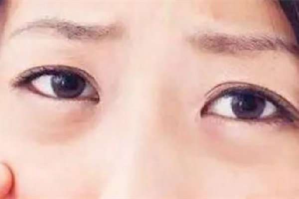 武漢下眼袋除皺手術(shù)多少錢(qián) 武漢下眼袋除皺手術(shù)去哪個(gè)醫(yī)院