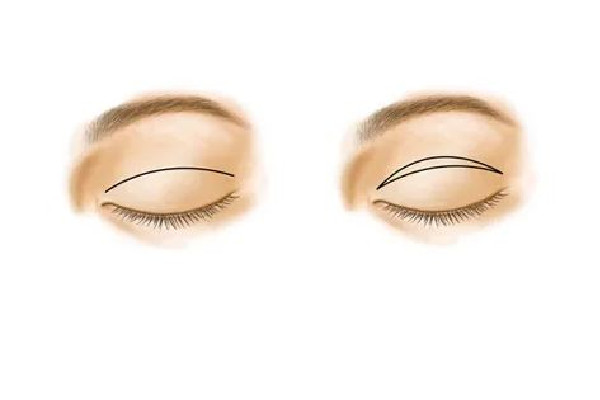 武漢做腫眼泡雙眼皮的醫(yī)院 武漢做腫眼泡雙眼皮多少錢(qián)