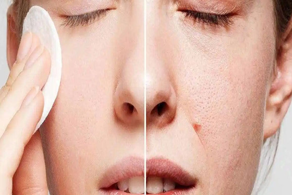 光谷天地美伽皮膚管理中心收縮毛孔效果好不好 收縮毛孔可以用水楊酸嗎 光谷天地美伽皮膚管理中心收縮毛孔效果好不好 收縮毛孔可以用水楊酸嗎