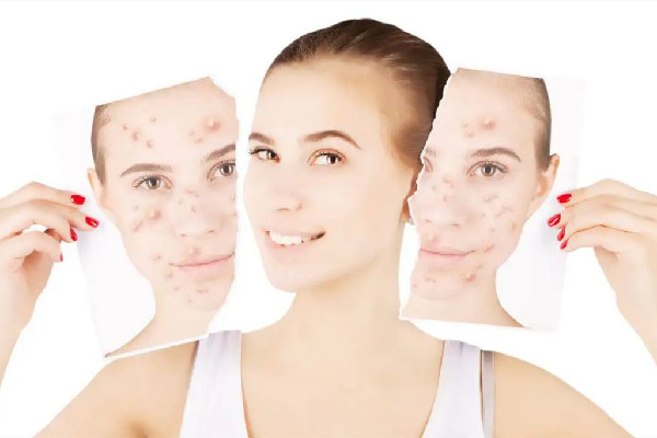 積玉橋俏佳人美容形象會所痘痘肌清理怎么樣 痘痘肌膚適合用什么洗面奶 積玉橋俏佳人美容形象會所痘痘肌清理怎么樣 痘痘肌膚適合用什么洗面奶