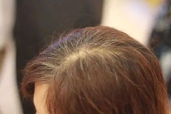 白頭發(fā)從哪開始白 白頭發(fā)為什么會(huì)越來越多