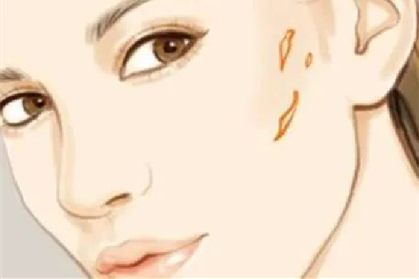 中南路正璞醫(yī)療美容·痘坑疤痕&皮膚微整店祛疤效果怎么樣 祛疤會越來越嚴重嗎