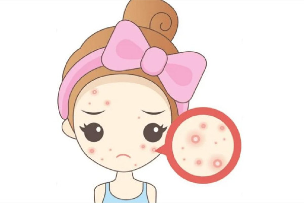 中南路蕾特恩專(zhuān)業(yè)祛痘·面部皮膚管理店痘痘肌護(hù)理好嗎 痘痘肌要一輩子忌口嗎