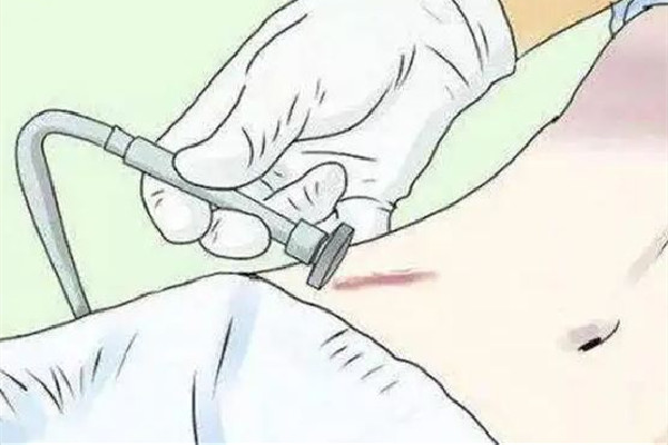 中南路欣奕除疤祛痘全國連鎖機構祛疤效果怎么樣 祛疤是越早越好嗎