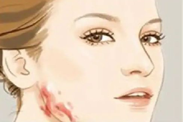 中南路欣奕除疤祛痘全國連鎖機(jī)構(gòu)祛疤效果怎么樣 祛疤是越早越好嗎 中南路欣奕除疤祛痘全國連鎖機(jī)構(gòu)祛疤效果怎么樣 祛疤是越早越好嗎