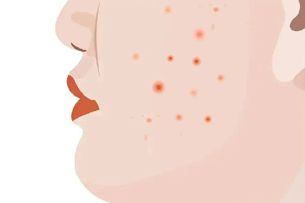 中南路Comely Lady美學中心店痘肌清潔怎么樣 痘肌多久用一次清潔面膜