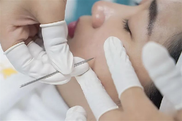 后湖SOR索爾祛痘?面部肌膚科學(xué)管理針清效果怎么樣 針清會(huì)讓毛孔變大嗎