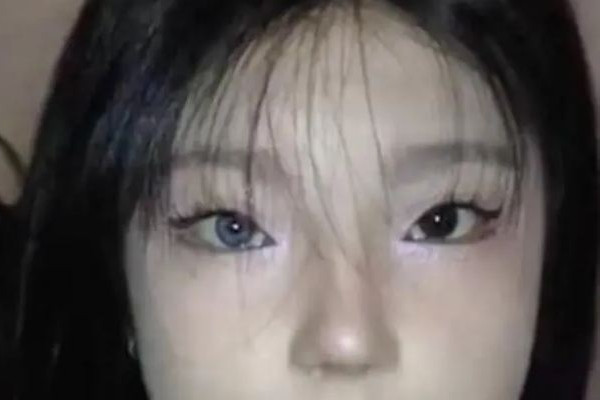 18歲女孩右眼天生藍瞳 為什么有的人瞳孔顏色不一樣