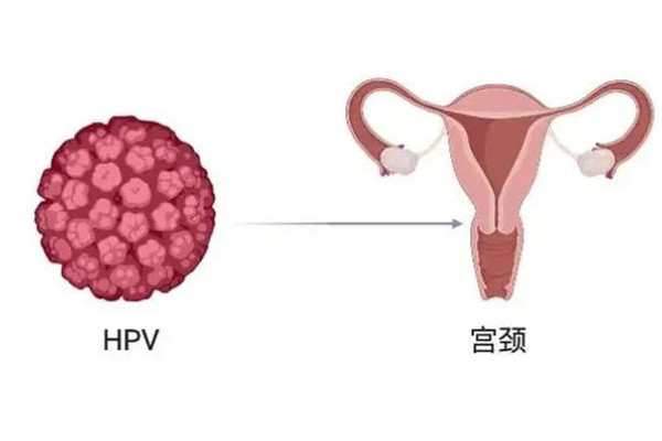 13歲女孩患宮頸癌7年 宮頸癌有什么癥狀表現(xiàn)有哪些 13歲女孩患宮頸癌7年 宮頸癌有什么癥狀表現(xiàn)有哪些