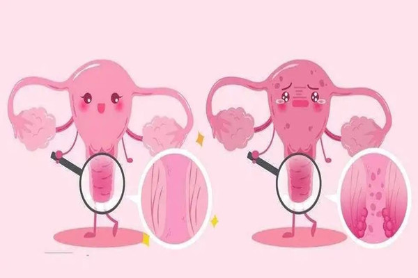 13歲女孩患宮頸癌7年 宮頸癌有什么癥狀表現(xiàn)有哪些 13歲女孩患宮頸癌7年 宮頸癌有什么癥狀表現(xiàn)有哪些