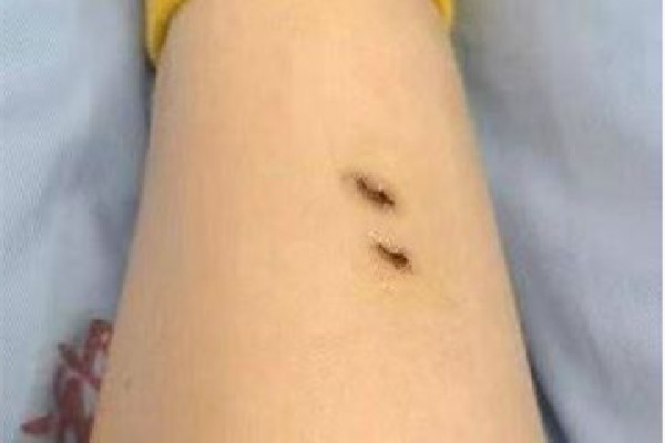 女子住酒店被毒蛇咬傷酒店拒擔全責 毒蛇一般在什么地方 女子住酒店被毒蛇咬傷酒店拒擔全責 毒蛇一般在什么地方